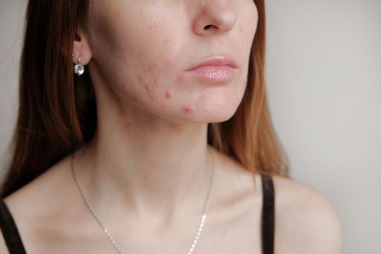 Post-Birth Control Acne + How to Clear it